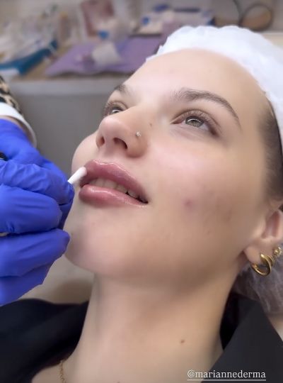 Primer plano de un procedimiento en la zona de los labios con manos enguantadas visibles